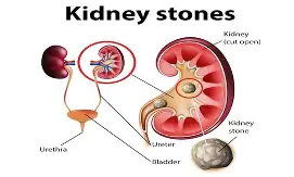 Kidney Stone